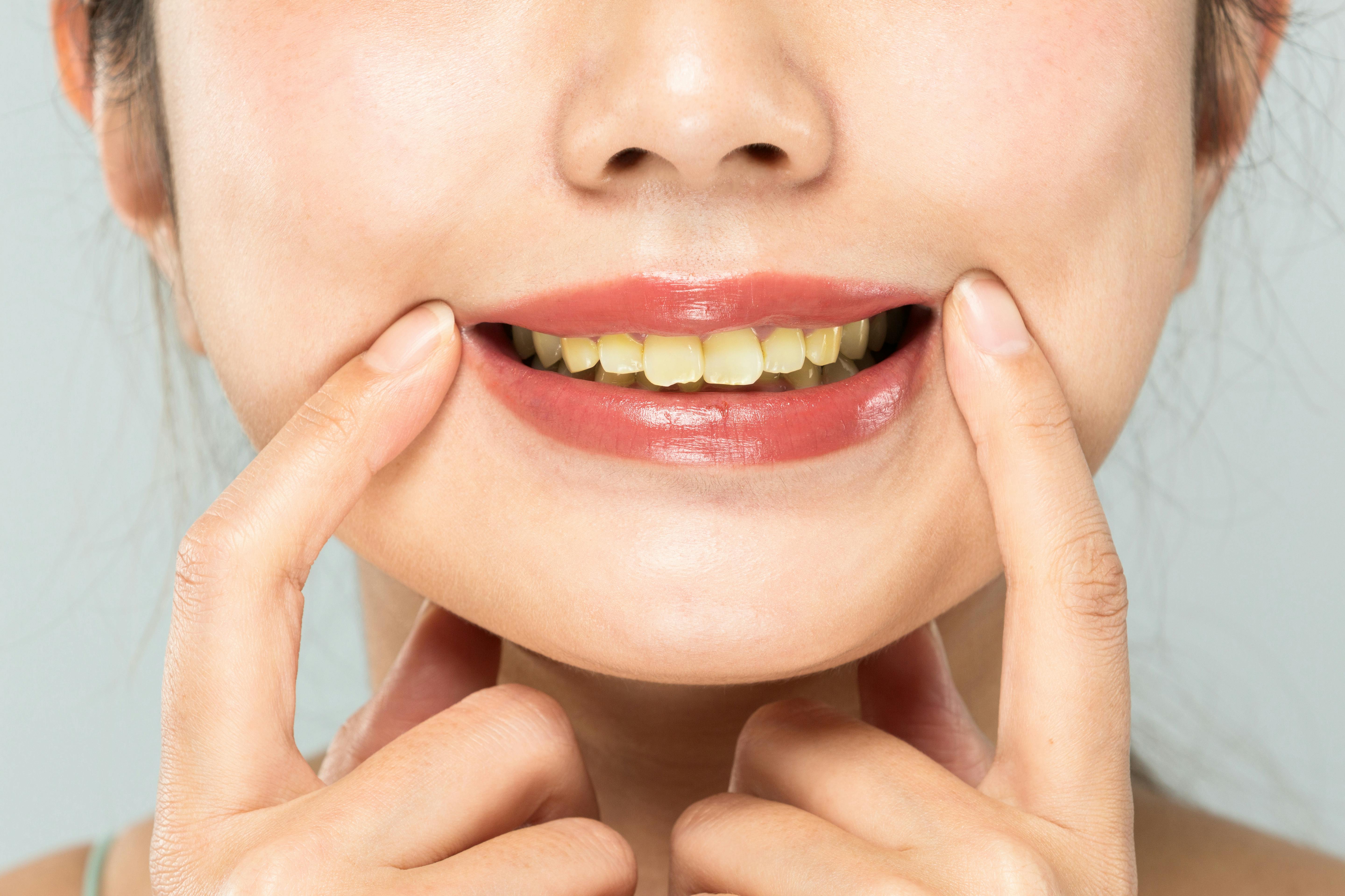 Woman with yellow teeth smiling