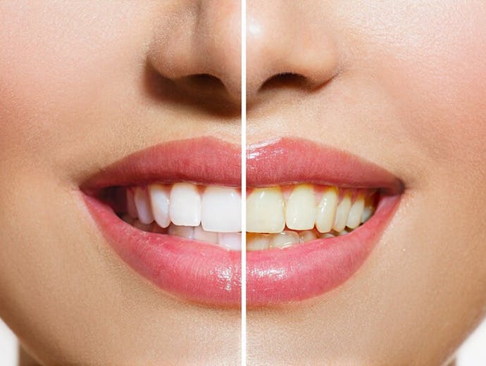 Yellow teeth whitening