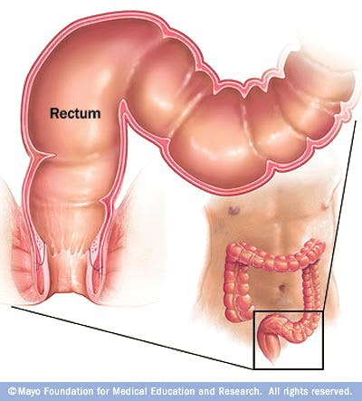 What are Hemorrhoids? What are Hemorrhoids?