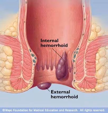 Who gets Hemorrhoids? Who gets Hemorrhoids?