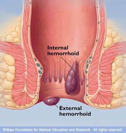 prolapsed hemorrhoid vs external