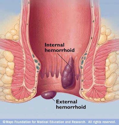 ¿Que son las hemorroides? ¿Que son las hemorroides?