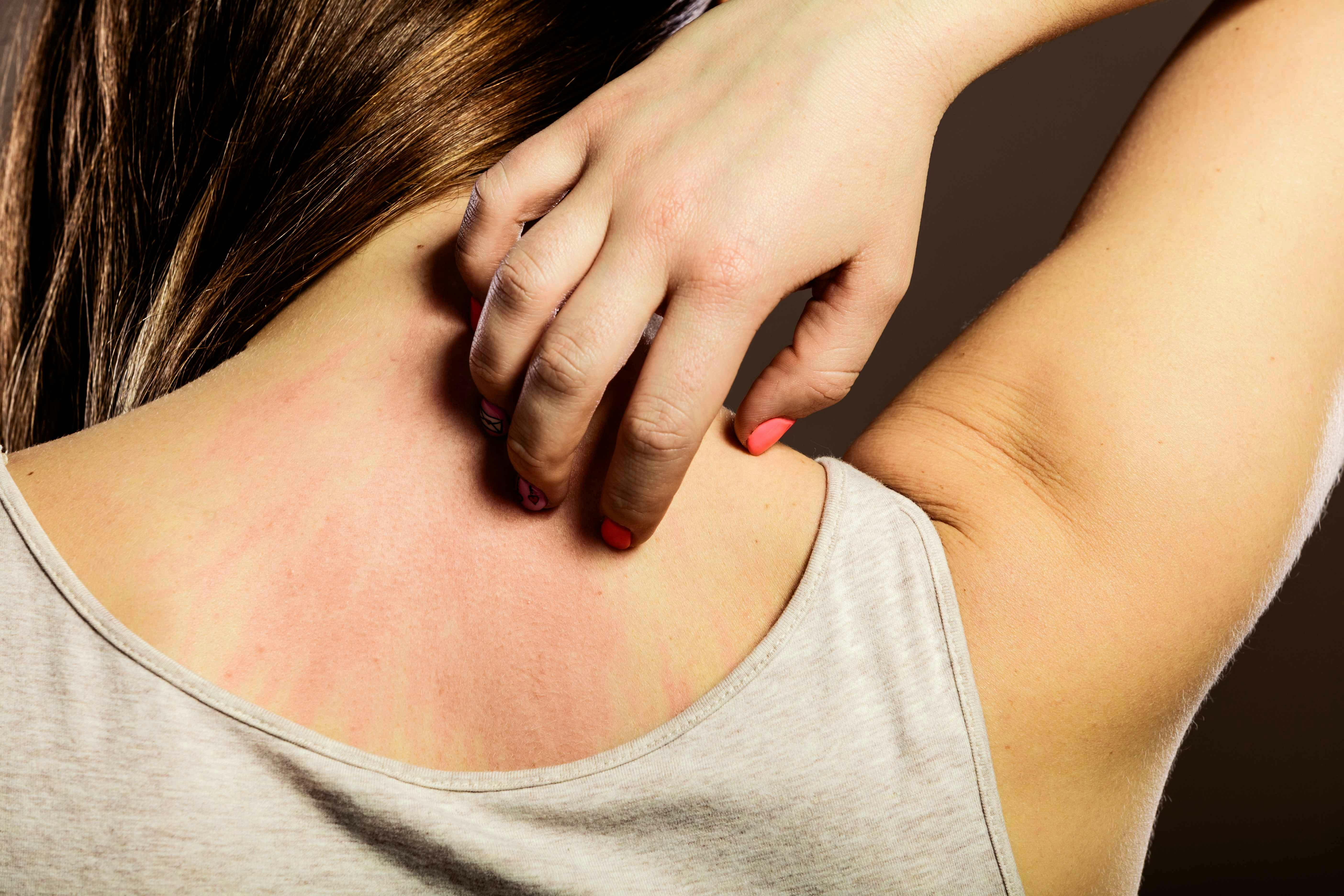 Woman scratches itchy skin on her back