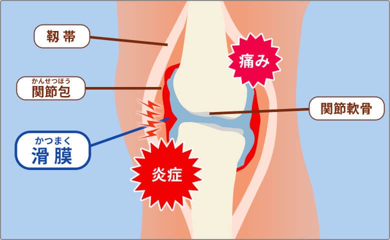 膝の関節がすり減る原因を示したイラスト 