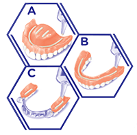 putting adhesive cream on upper dentures