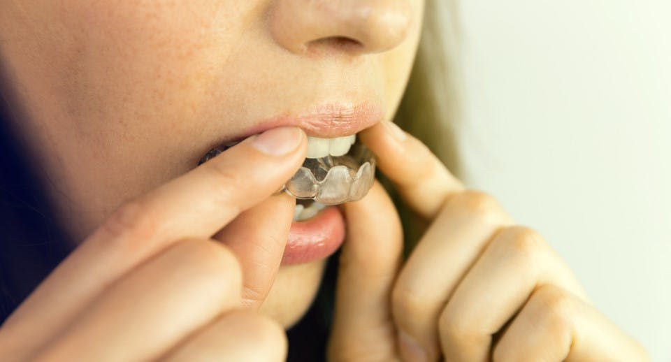 A women removing her retainer