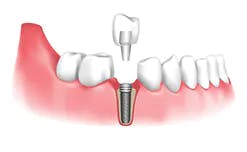 Denture Relines Leamington