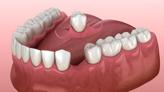 3D model of a removeable single tooth denture being attached to a mouth