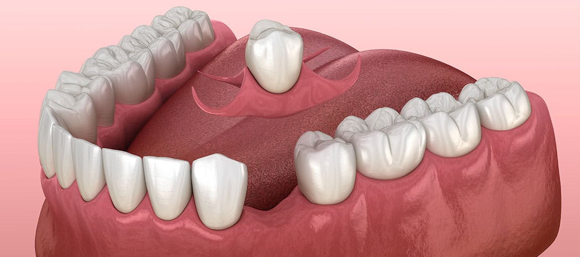 3D model of a removeable single tooth denture being attached to a mouth