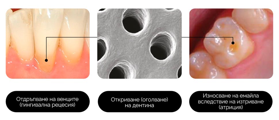 Причини за открития дентин