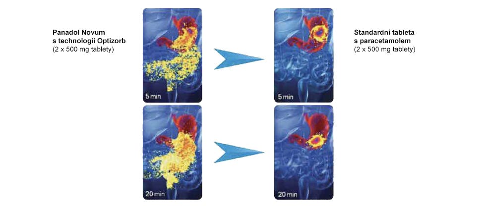 Obrázky zobrazující rychlost rozpadu tablet Panadol Novum v porovnání se standardními tabletami s obsahem paracetamolu v žaludku
