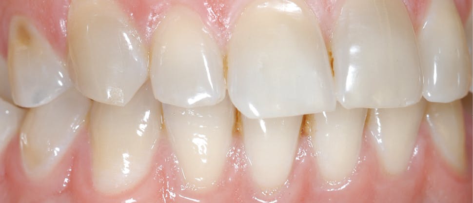 Snímek opotřebení zubní skloviny
