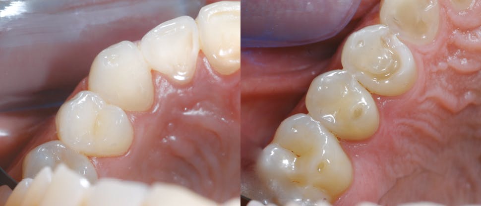 Další příznaky opotřebení zubní skloviny