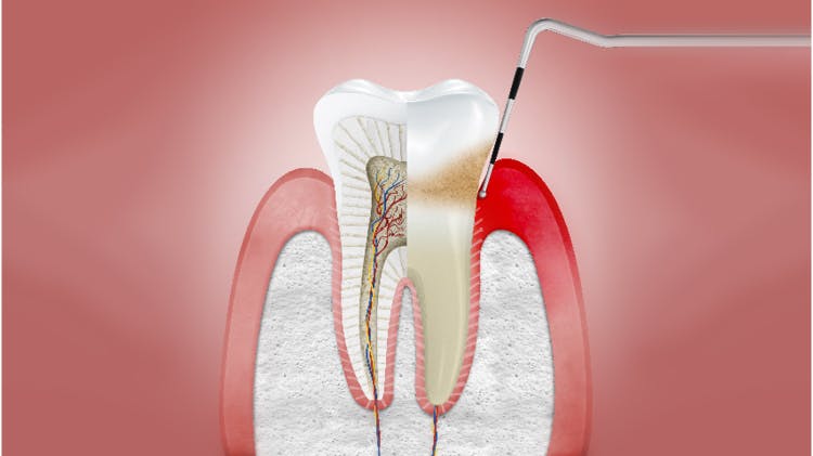 Průřez dásněmi s gingivitidou