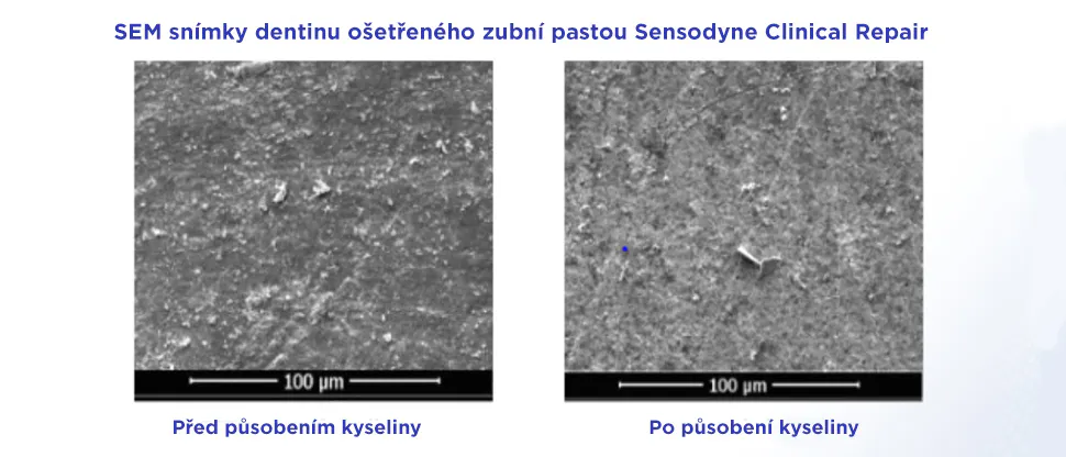 Snímky dentinových tubulů ošetřených zubní pastou Sensodyne Clinical Repair před a po působení kyseliny, demonstrující odolnost vytvořené vrstvy