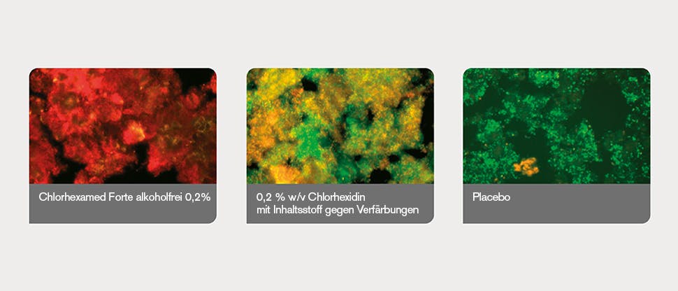 Plaque-Biofilme durch Bildanalyseprogramm bestimmt