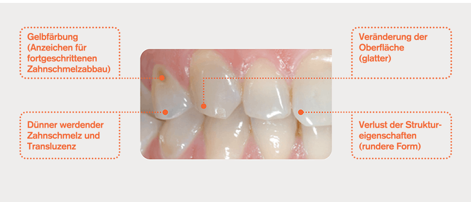 Teeth with worn enamel