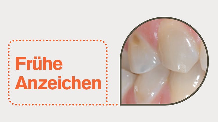 Frühe Anzeichen von Zahnschmelzabbau