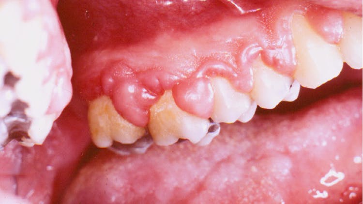 Zahnfleischwucherung