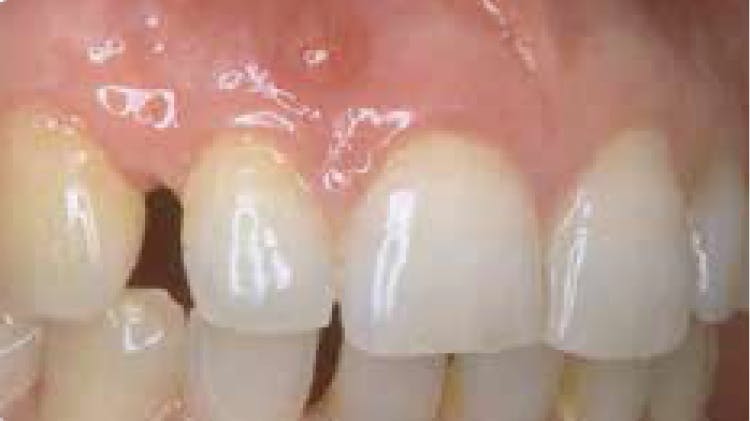 Parodontitis im Zusammenhang mit endodontischen Läsionen