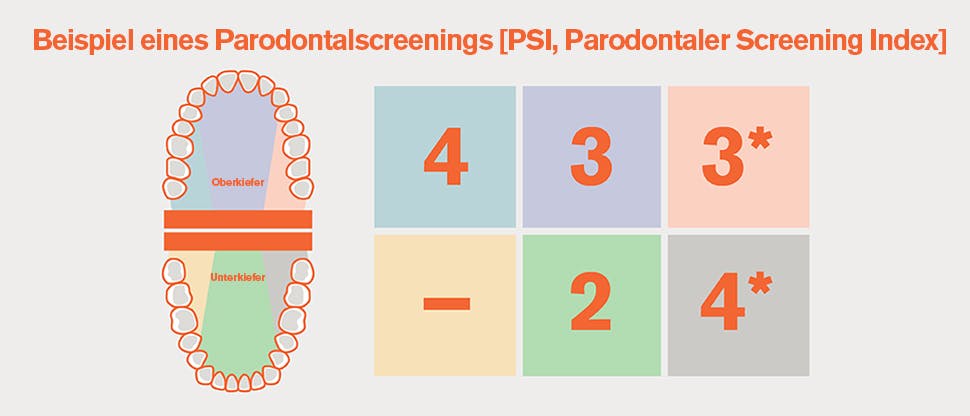 PSI - Einteilung des Gebisses in Sextanten und Beispiel eines Parodontalscreenings