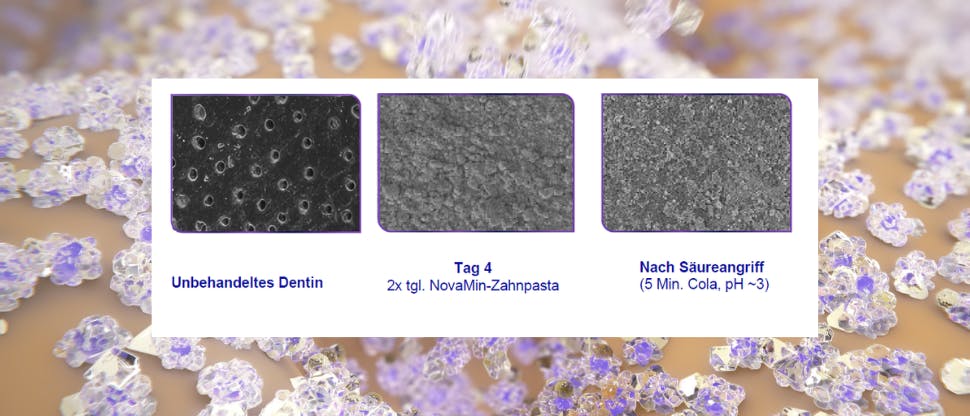 Die zahnschmelz-ähnliche Schutzschicht hält Säureangriffen stand