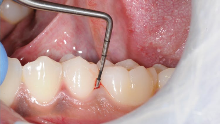 Ασθενής με αιμορραγία των ούλων