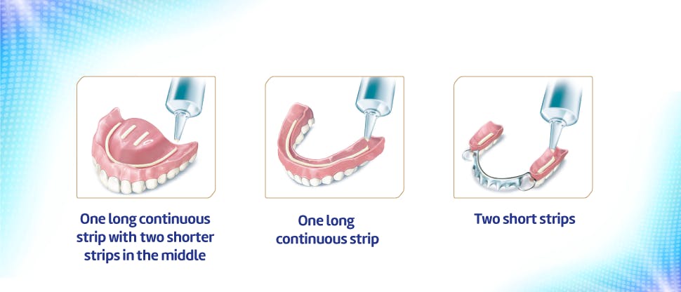 Εικόνα στερεωτικής κρέμας οδοντοστοιχίας που εφαρμόζεται σε τεχνητή οδοντοστοιχία