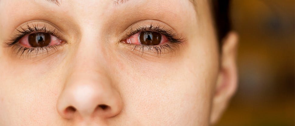 Woman with red, watery eyes