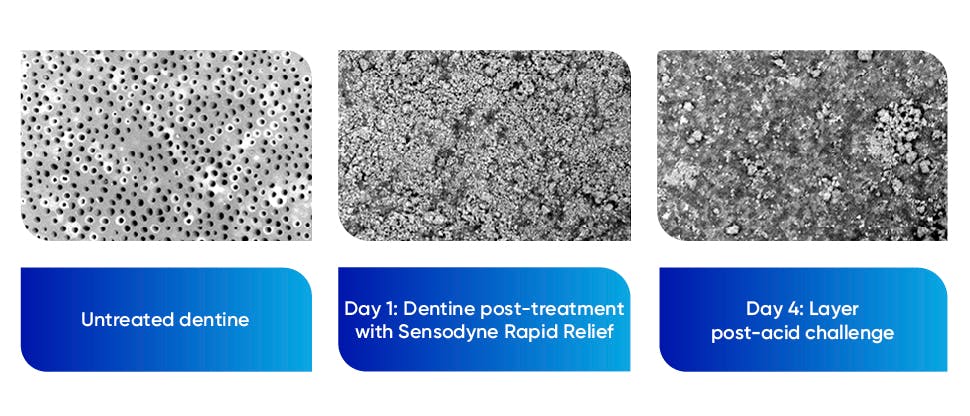 Close-up images of dentine before and after stannous  fluoride treatment