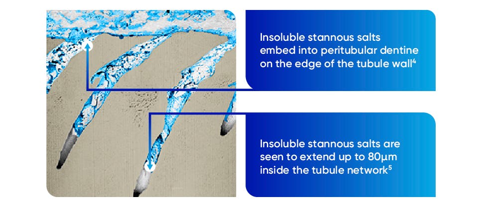 Insoluble stannous salts embedding into dentine