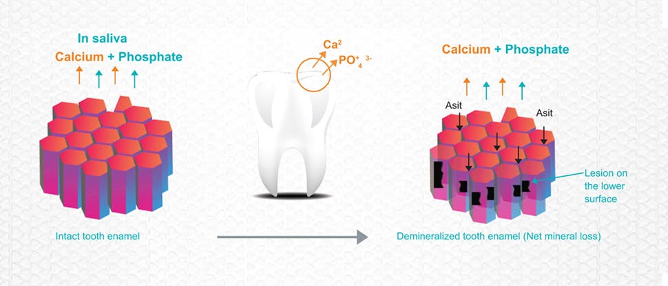 Demineralization