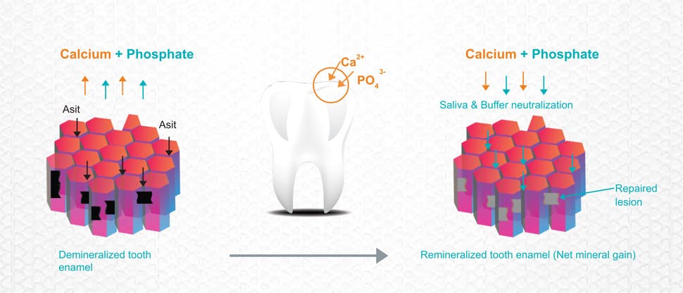 Remineralisation