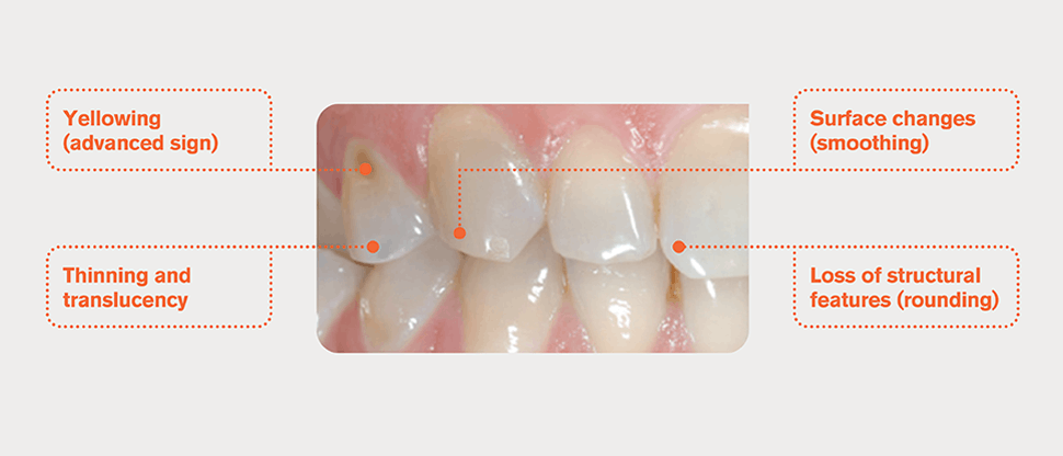Teeth with worn enamel