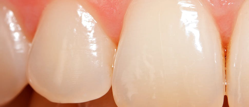 Enamel worn teeth