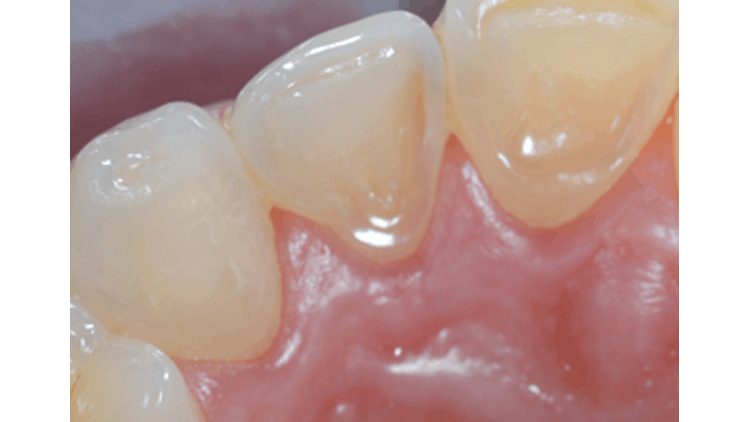 Enamel worn teeth