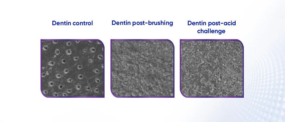 Scanning electron microscope (SEM) images of dentin surface showing layer formed post brushing retained after acid challenge 