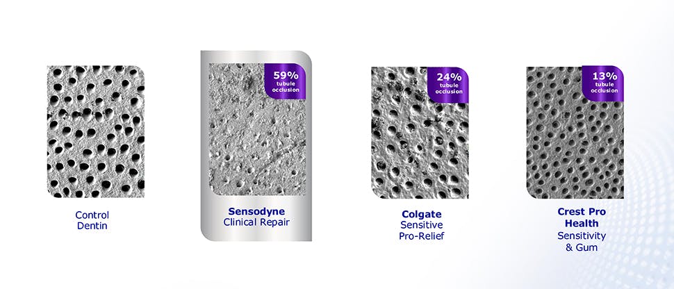 Image of dentin tubules after treatment with toothpaste