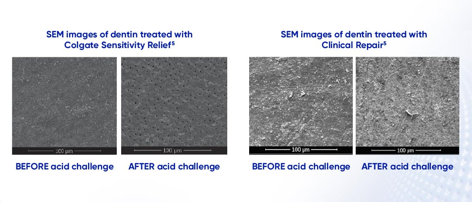 Images of dentin treated with SENSODYNE Clinical Repair Toothpaste and Colgate Sensitivity Relief before and after acid challenge to show resistance