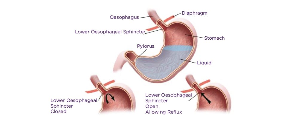 Image of stomach showing cause of heartburn