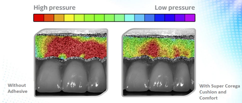 Pressure relieved on gums by using Corega adhesive