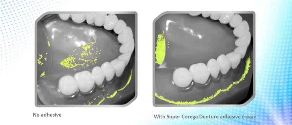 Food entrapment images with and without Corega adhesive
