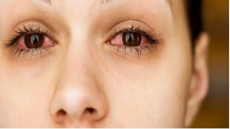 Image of woman with allergies