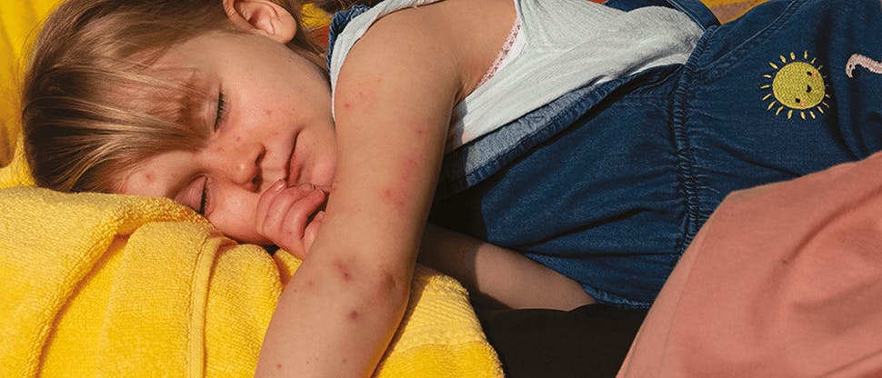 Image of girl with chicken pox rash