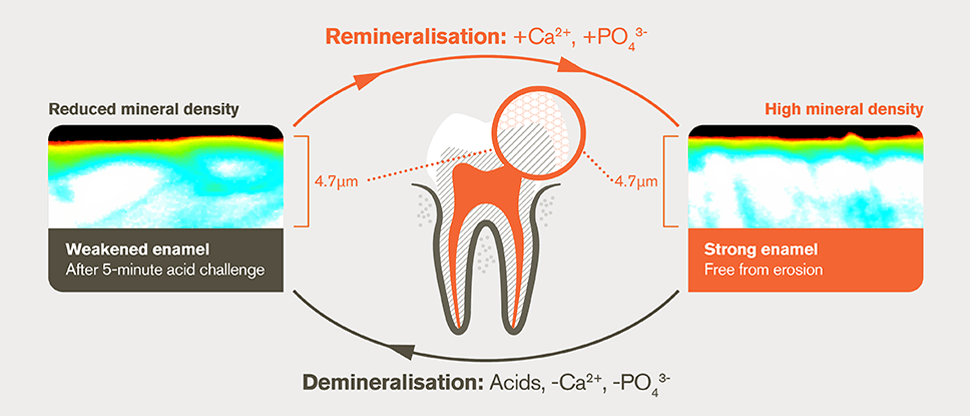 Demineralisation and remineralisation process after 5-minute acid challenge
