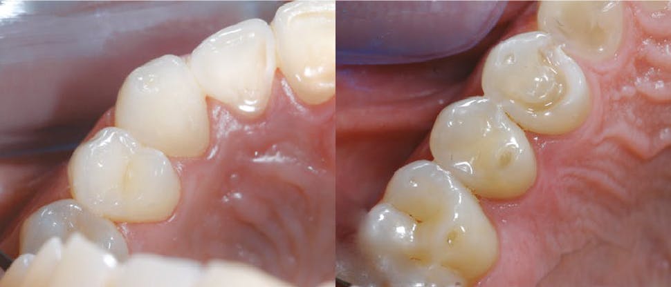 Image of teeth impacted by erosive tooth wear