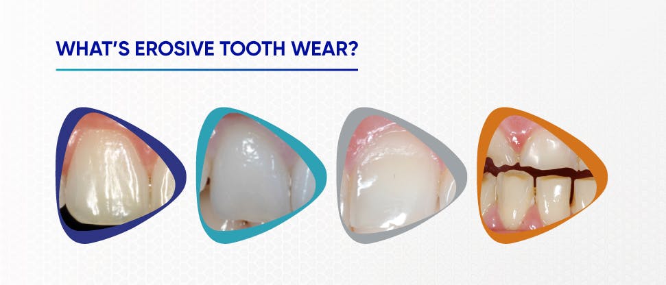 Image showing teeth with erosive tooth wear