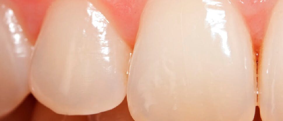 Close-up image of teeth with erosive tooth wear