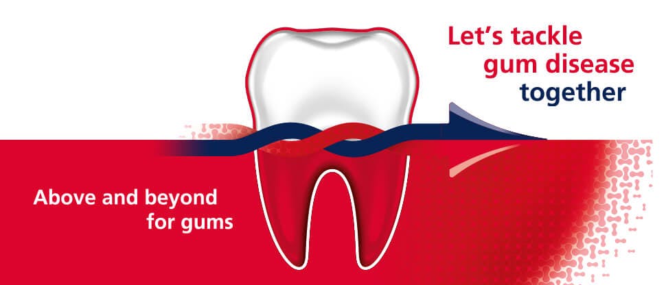 Icon of tooth showing how Corsodyl is helping to tackle gum disease.