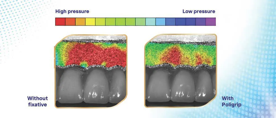 Visual showing that pressure is relieved on gums by using Poligrip fixative vs without fixative